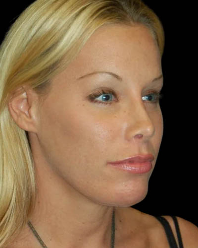 Facial Fat Grafting case #4495
