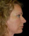 Facelift case #4376