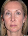 Facelift case #4369