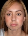 Facial Fat Grafting case #4492