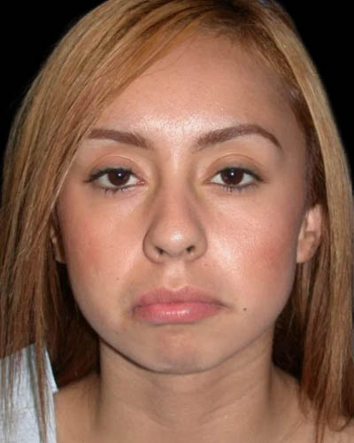 Facial Fat Grafting case #4492