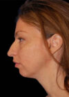 Chin Implant case #4183