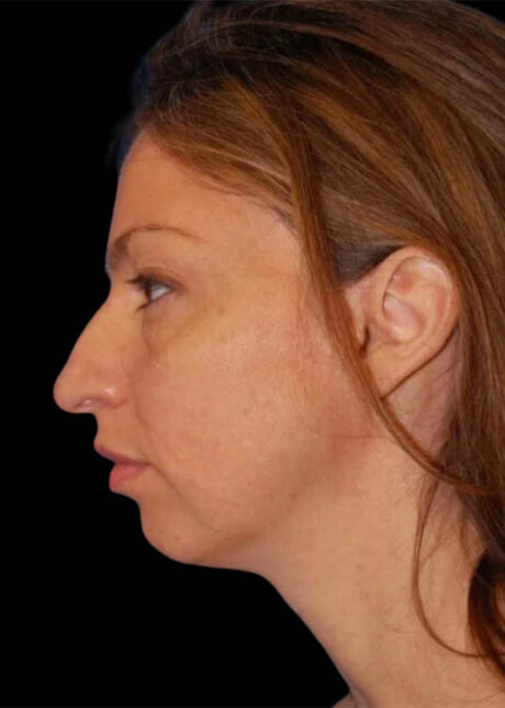 Chin Implant case #4183