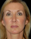 Facelift case #4369