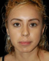 Facial Fat Grafting case #4492