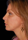 Chin Implant case #4183