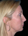 Facelift case #4369