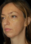 Chin Implant case #4183