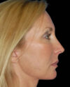 Facelift case #4369