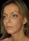 Chin Implant case #4183
