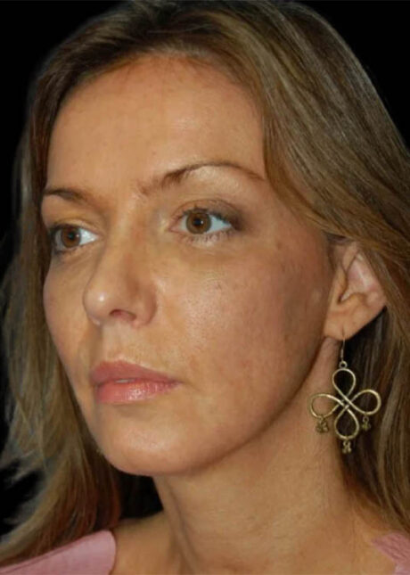 Chin Implant case #4183