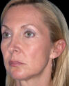 Facelift case #4369