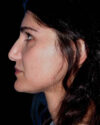 Facial Fat Grafting case #4487