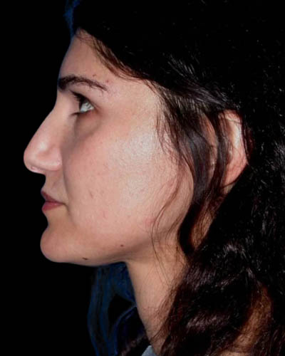 Facial Fat Grafting case #4487