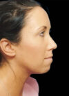 Chin Implant case #4176