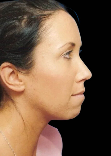 Chin Implant case #4176