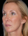 Facelift case #4369