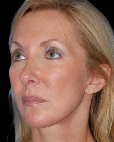 Facelift case #4369
