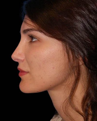 Facial Fat Grafting case #4487