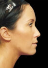 Chin Implant case #4176