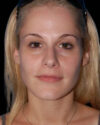 Facial Fat Grafting case #4484