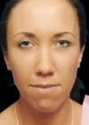 Chin Implant case #4176