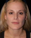 Facial Fat Grafting case #4484