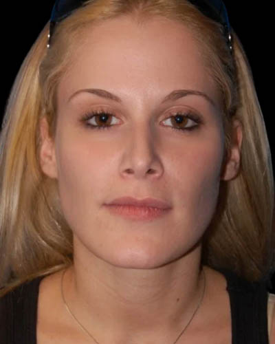 Facial Fat Grafting case #4484