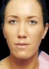 Chin Implant case #4176