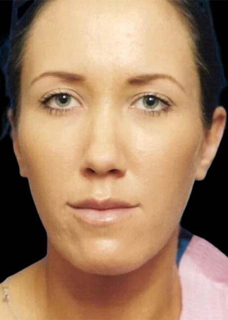 Chin Implant case #4176