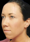 Chin Implant case #4176