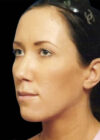 Chin Implant case #4176