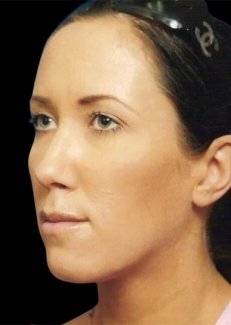 Chin Implant case #4176