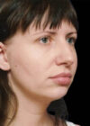 Chin Implant case #4219
