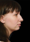 Chin Implant case #4219