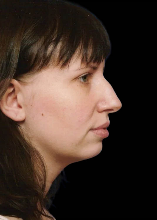 Chin Implant case #4219