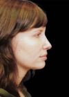 Chin Implant case #4219