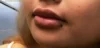 Dermal Fillers case #4363