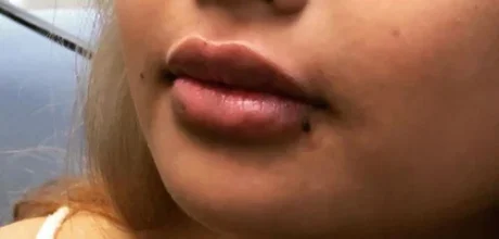 Dermal Fillers case #4363