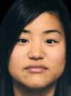 Buccal Fat Removal case #4168
