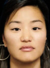 Buccal Fat Removal case #4168