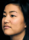 Buccal Fat Removal case #4168