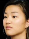 Buccal Fat Removal case #4168