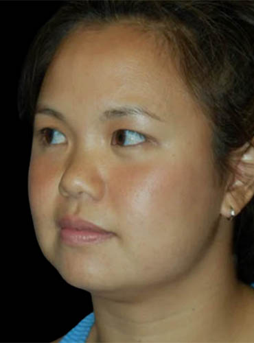 Buccal Fat Removal case #4114