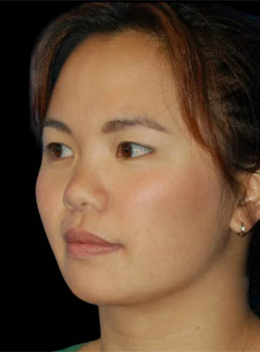Buccal Fat Removal case #4114