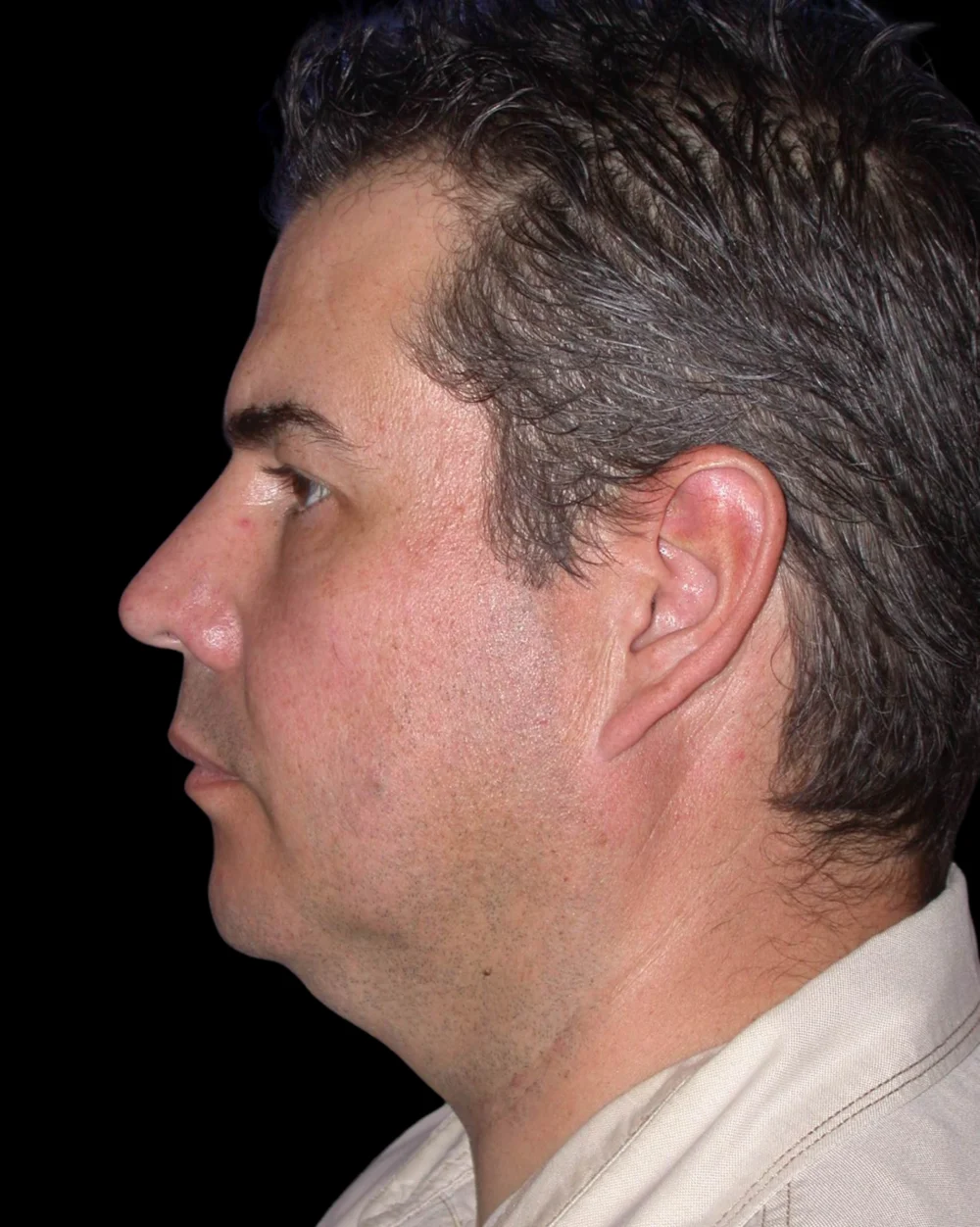 Neck Lift case #4857