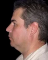 Neck Lift case #4857