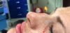 Dermal Fillers case #4360
