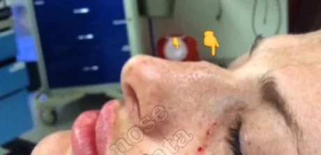 Dermal Fillers case #4360