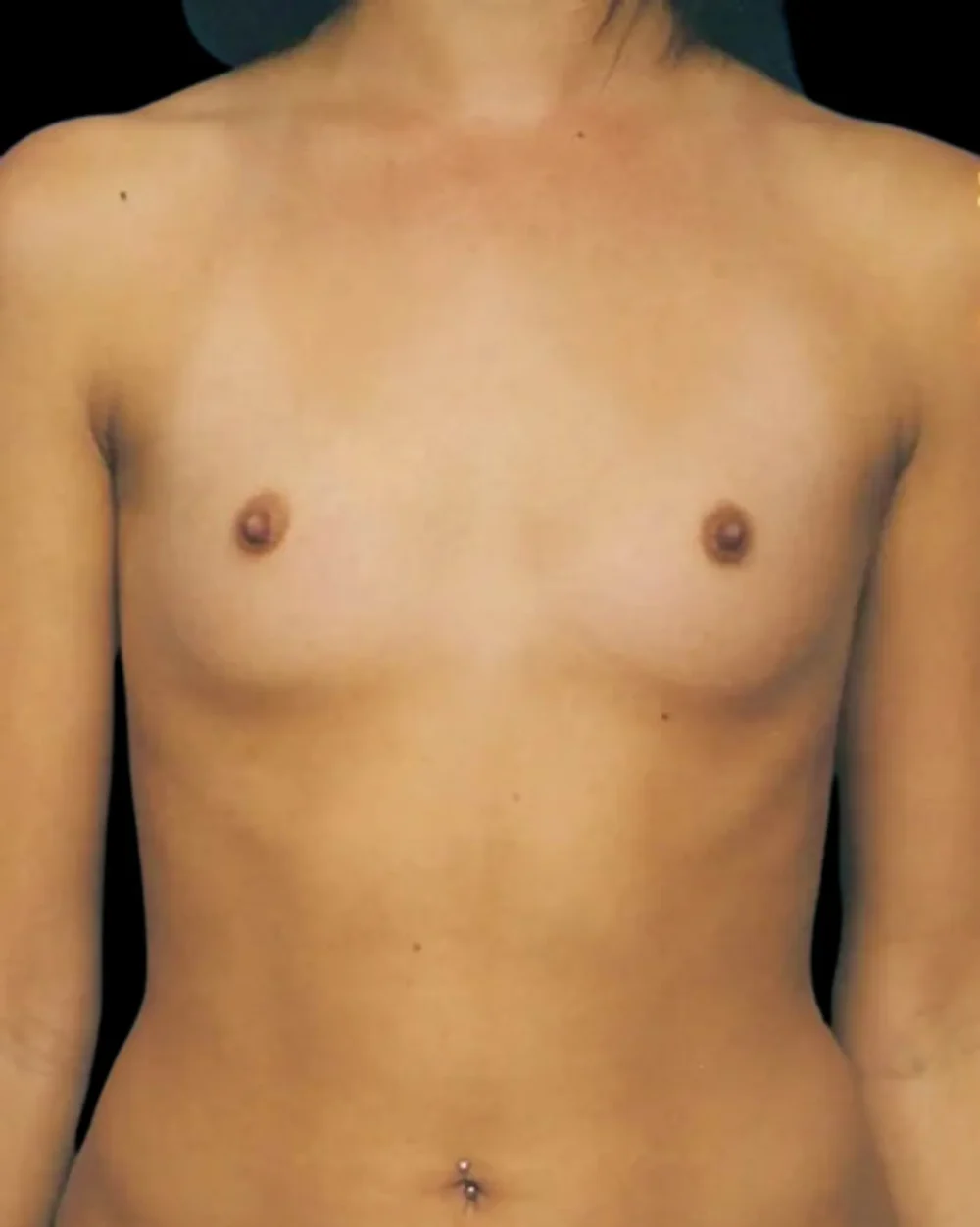 Breast Augmentation case #3620